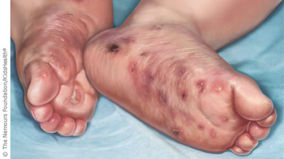 Herpetic whitlow on bottom of foot right! Something herpetic whitlow on bottom of foot you